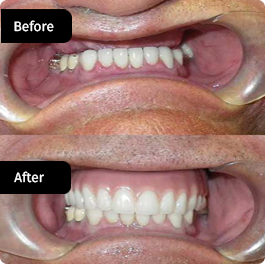 before-after-small-10-264x264