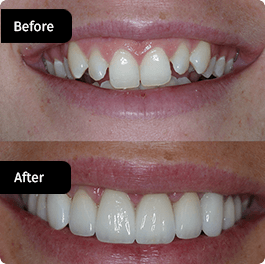 before-after-small-3-264x264