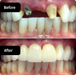 before-after-small-9-264x264